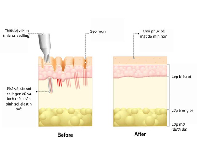 V&igrave; sao laser, b&oacute;c t&aacute;ch xong sẹo vẫn l&otilde;m lại? Chuy&ecirc;n gia giải th&iacute;ch cơ chế- Ảnh 4.