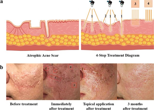 V&igrave; sao laser, b&oacute;c t&aacute;ch xong sẹo vẫn l&otilde;m lại? Chuy&ecirc;n gia giải th&iacute;ch cơ chế- Ảnh 5.