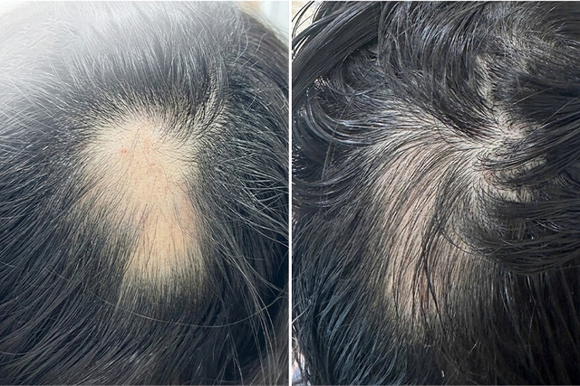 Nguyên nhân khiến thiếu nữ 16 tuổi rụng tóc từng mảng - Ảnh 2.