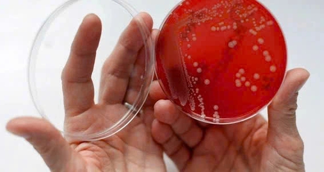   'Si&ecirc;u vi khuẩn' tấn c&ocirc;ng n&atilde;o, tim khiến c&ocirc; g&aacute;i nguy kịch - Ảnh 1.