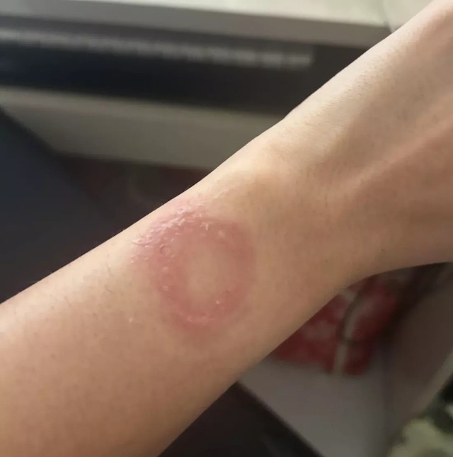 Apple Watch g&acirc;y bỏng cổ tay người d&ugrave;ng, Apple im lặng suốt 6 th&aacute;ng - Ảnh 1.