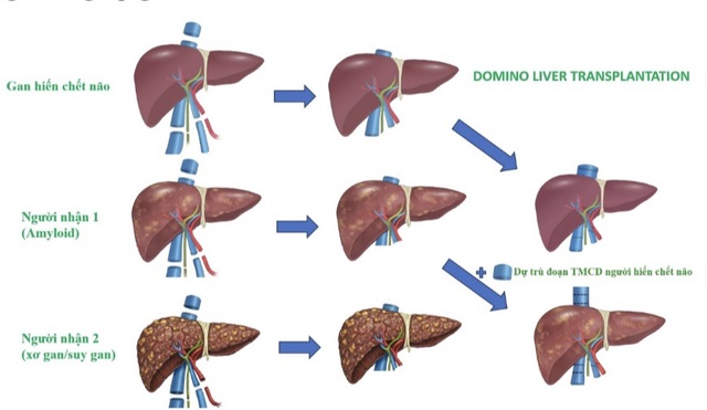 Lần đầu ti&ecirc;n thực hiện 'gh&eacute;p đa tạng domino' tại Việt Nam- Ảnh 1.