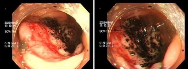 Đau bụng tưởng b&igrave;nh thường, nhiều người trẻ mắc ung thư đại trực tr&agrave;ng khi đ&atilde; muộn- Ảnh 1.