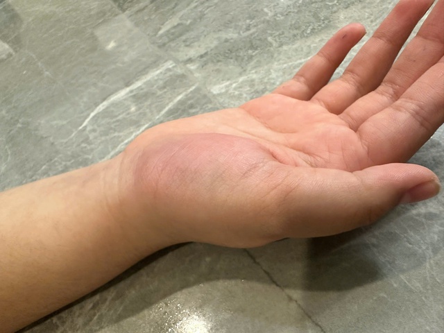 X&ocirc;n xao việc gi&aacute;o vi&ecirc;n d&ugrave;ng thước đ&aacute;nh học sinh tiểu học g&atilde;y tay - Ảnh 2.