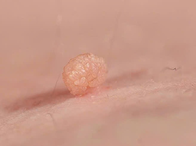 Tình dục không an toàn, nam bệnh nhân gần 70 tuổi mắc sùi mào gà - Ảnh 1.