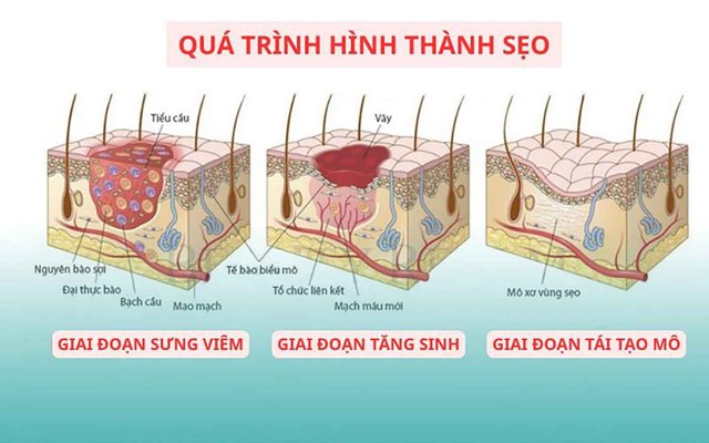 Áp lực cơ học và tăng sinh collagen: Góc nhìn mới trong phòng ngừa sẹo hậu phẫu- Ảnh 2. Áp lực cơ học và tăng sinh collagen: Góc nhìn mới trong phòng ngừa sẹo hậu phẫu- Ảnh 2.