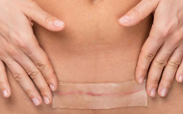 Áp lực cơ học và tăng sinh collagen: Góc nhìn mới trong phòng ngừa sẹo hậu phẫu- Ảnh 3. Áp lực cơ học và tăng sinh collagen: Góc nhìn mới trong phòng ngừa sẹo hậu phẫu- Ảnh 3.