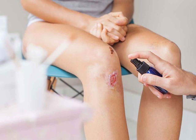Cách giúp vết thương hở nhanh lành chuẩn y khoa ngăn ngừa nhiễm trùng và sẹo xấu- Ảnh 2. Cách giúp vết thương hở nhanh lành chuẩn y khoa ngăn ngừa nhiễm trùng và sẹo xấu- Ảnh 2.