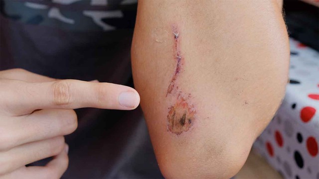 Cách giúp vết thương hở nhanh lành chuẩn y khoa ngăn ngừa nhiễm trùng và sẹo xấu- Ảnh 3. Cách giúp vết thương hở nhanh lành chuẩn y khoa ngăn ngừa nhiễm trùng và sẹo xấu- Ảnh 3.