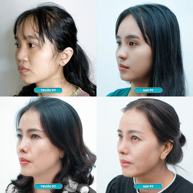 Bệnh viện JK Nhật H&agrave;n miễn ph&iacute; phẫu thuật 20 case mũi - Ảnh 1.