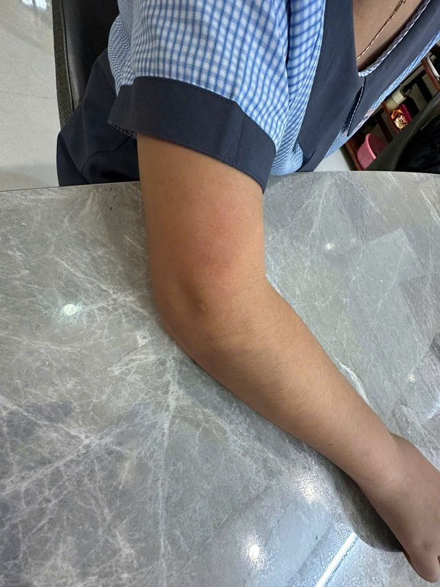 Đ&atilde; x&aacute;c minh vụ c&ocirc; gi&aacute;o d&ugrave;ng thước đ&aacute;nh học sinh tiểu học 'chấn thương' ở tay - Ảnh 3.