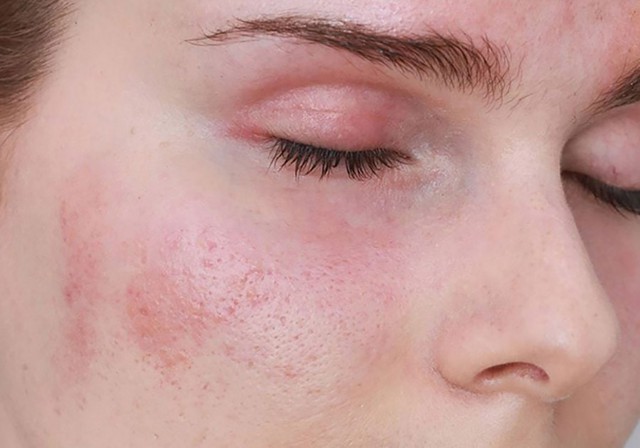 Plasma Lạnh trong da liễu c&oacute; thể thay thế laser kh&ocirc;ng?- Ảnh 7.