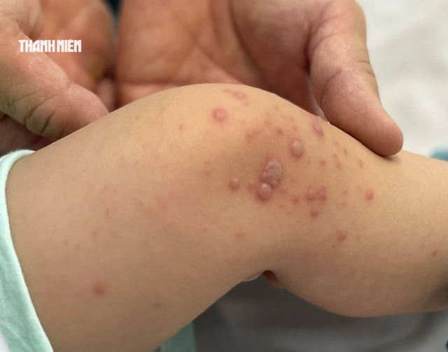 TP.HCM: Bệnh tay ch&acirc;n miệng tăng mạnh, hơn 8.150 ca mắc, 4 ca tử vong- Ảnh 1.