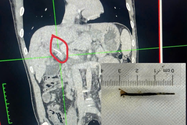 H&oacute;c xương c&aacute; g&acirc;y tắc mật: C&acirc;u chuyện hi hữu của bệnh nh&acirc;n 45 tuổi - Ảnh 1.