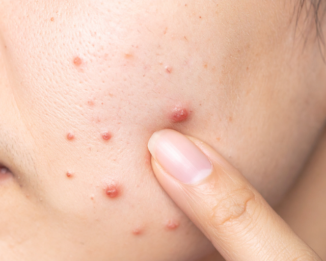 Vừa nặn mụn xong nên bôi gì để giảm đỏ nhanh hạn chế để lại sẹo rỗ - Ảnh 1.