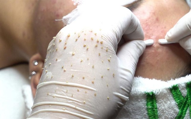 Vừa nặn mụn xong nên bôi gì để giảm đỏ nhanh hạn chế để lại sẹo rỗ - Ảnh 2.