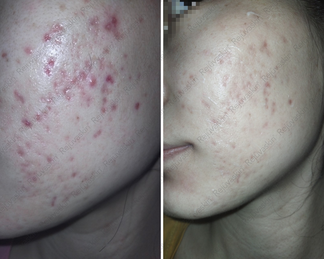 Vừa nặn mụn xong nên bôi gì để giảm đỏ nhanh hạn chế để lại sẹo rỗ - Ảnh 3.