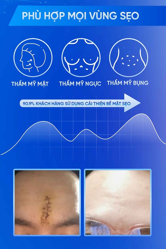 Hướng dẫn sử dụng kem l&agrave;m mờ sẹo lồi Rejuvasil chuẩn y khoa hiệu quả 4 tuần - Ảnh 5.