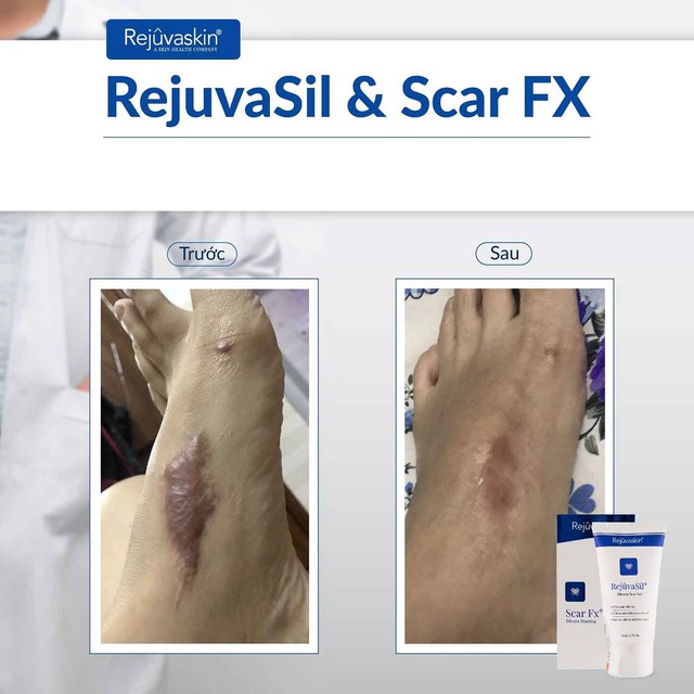 Hướng dẫn sử dụng kem l&agrave;m mờ sẹo lồi Rejuvasil chuẩn y khoa hiệu quả 4 tuần - Ảnh 7.