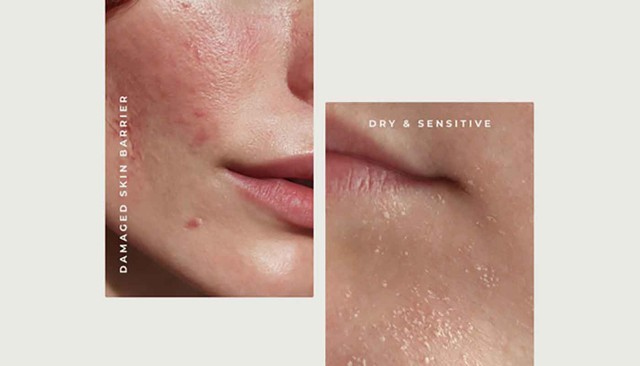 Da yếu là gì? Dấu hiệu và cách phục hồi hiệu quả trong 4 tuần- Ảnh 1. Da yếu là gì? Dấu hiệu và cách phục hồi hiệu quả trong 4 tuần- Ảnh 1.