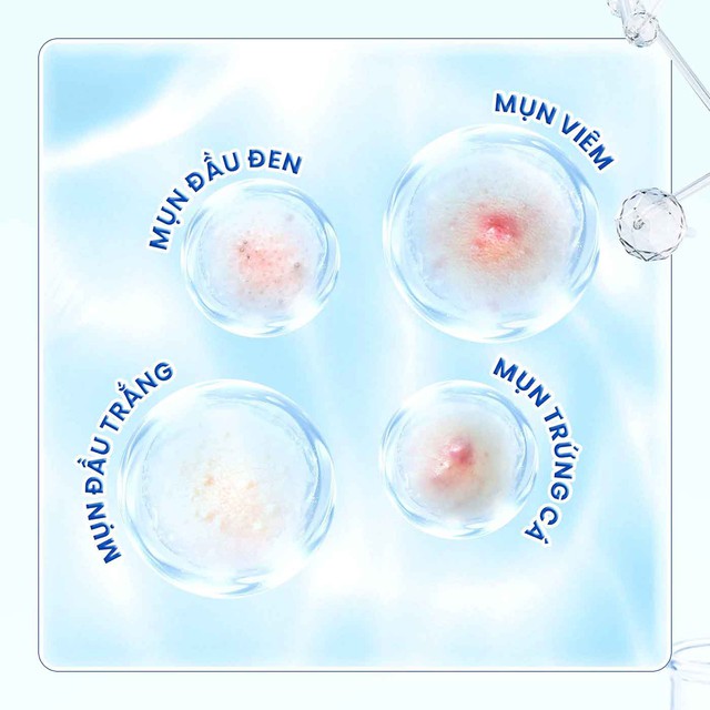 Review kem ch&acirc;́m mụn Trioderma Anti Acne Gel c&oacute; l&agrave;m xẹp mụn vi&ecirc;m sau khoảng 48 giờ? - Ảnh 8.