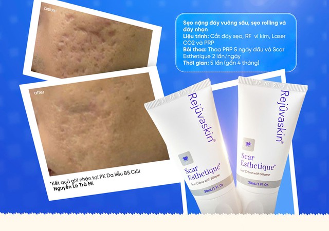 C&aacute;ch mờ sẹo mụn sau laser: Giảm vi&ecirc;m, hỗ trợ l&agrave;nh thương v&agrave; t&aacute;i tạo thể t&iacute;ch - Ảnh 1.