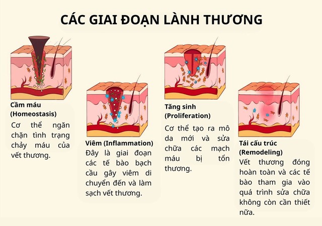 C&aacute;ch mờ sẹo mụn sau laser: Giảm vi&ecirc;m, hỗ trợ l&agrave;nh thương v&agrave; t&aacute;i tạo thể t&iacute;ch - Ảnh 3.
