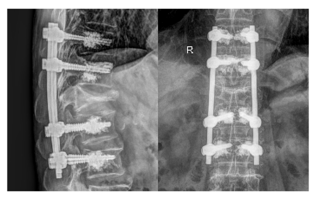 Tho&aacute;t cảnh ngồi xe lăn sau 3 ng&agrave;y phẫu thuật cột sống - Ảnh 3.