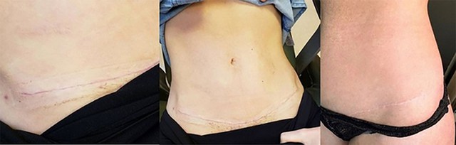 Hướng dẫn sử dụng miếng d&aacute;n sẹo Scar FX đ&uacute;ng c&aacute;ch đạt hiệu quả sau 4 tuần- Ảnh 8.