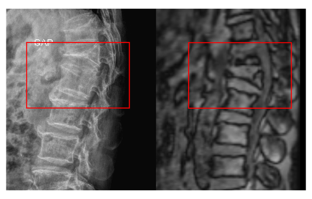 Tho&aacute;t cảnh ngồi xe lăn sau 3 ng&agrave;y phẫu thuật cột sống - Ảnh 1.