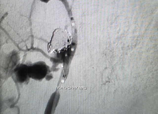  Cứu sống bệnh nhân ung thư biến chứng chảy máu ồ ạt - Ảnh 1.