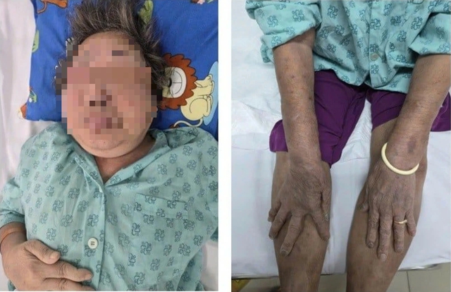 Tự uống thuốc giảm đau, cụ ông 87 tuổi nhập viện ở TP.HCM- Ảnh 1.