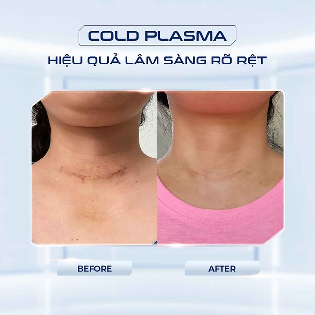 Cold Plasma trong hỗ trợ phục hồi vết thương: Cơ chế v&agrave; ứng dụng l&acirc;m s&agrave;ng - Ảnh 5.