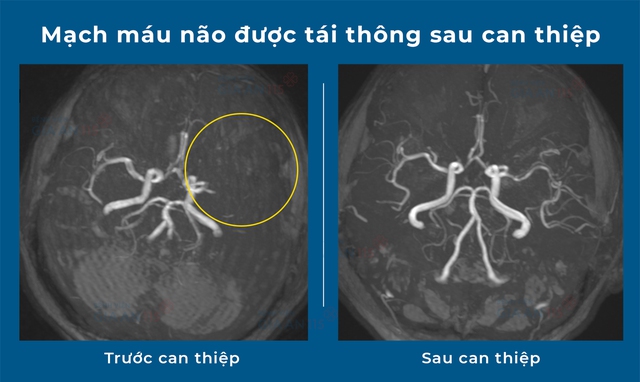 Can thiệp đột quỵ th&agrave;nh c&ocirc;ng ở giờ thứ 34 với sự hỗ trợ của h&igrave;nh ảnh học ti&ecirc;n tiến - Ảnh 1.