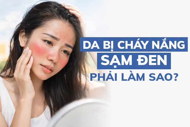 Nắng nóng gần 40 độ: Da bỏng rát, sạm màu? Cách phục hồi sau 1 đêm- Ảnh 1. Nắng nóng gần 40 độ: Da bỏng rát, sạm màu? Cách phục hồi sau 1 đêm- Ảnh 1.