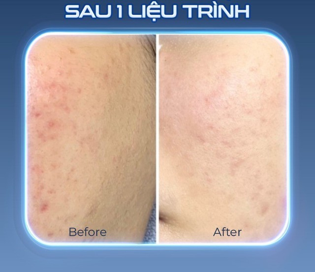 Tia plasma có nguy hiểm không? Ứng dụng của Plasma Lạnh trong thẩm mỹ da liễu? - Ảnh 3.