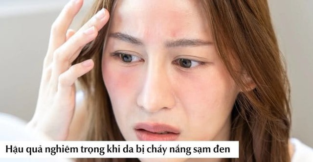 Nắng nóng gần 40 độ: Da bỏng rát, sạm màu? Cách phục hồi sau 1 đêm- Ảnh 3. Nắng nóng gần 40 độ: Da bỏng rát, sạm màu? Cách phục hồi sau 1 đêm- Ảnh 3.