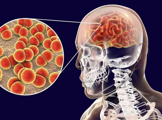 Cà Mau ghi nhận 3 ca nghi viêm não mô cầu, 1 trường hợp tử vong - Ảnh 1.