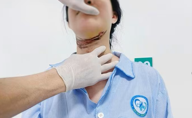 Nữ sinh ở Quảng Trị bị dây giăng ngang đường cứa vào cổ khi đi học về- Ảnh 1. Nữ sinh ở Quảng Trị bị dây giăng ngang đường cứa vào cổ khi đi học về- Ảnh 1.