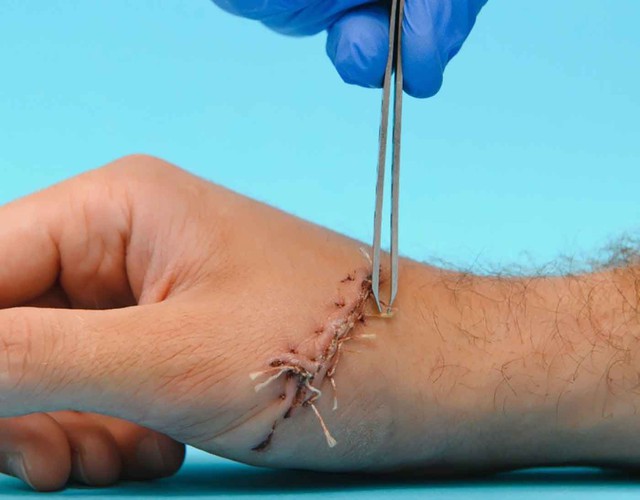 Timeline hồi phục sau cắt chỉ: Chăm sóc vết thương không để lại sẹo- Ảnh 1. Timeline hồi phục sau cắt chỉ: Chăm sóc vết thương không để lại sẹo- Ảnh 1.