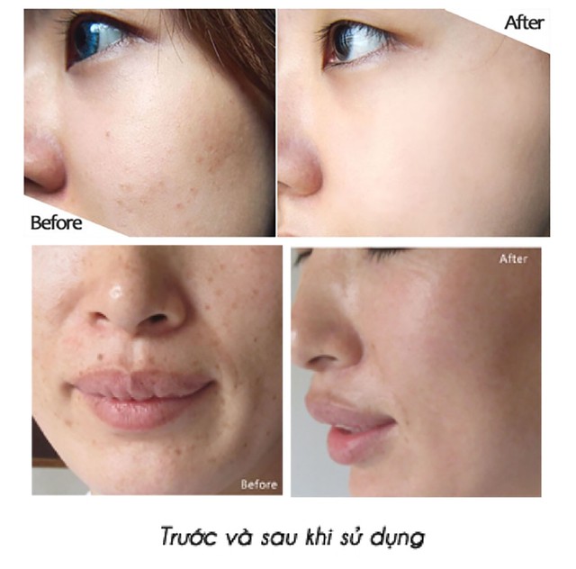 Top 5 kem mờ nám 'đắt tiền đến mấy' cũng mua vì hiệu quả nám chân sâu
- Ảnh 5. Top 5 kem mờ nám 'đắt tiền đến mấy' cũng mua vì hiệu quả nám chân sâu
- Ảnh 5.