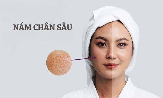 Top 5 kem mờ nám 'đắt tiền đến mấy' cũng mua vì hiệu quả nám chân sâu
- Ảnh 1. Top 5 kem mờ nám 'đắt tiền đến mấy' cũng mua vì hiệu quả nám chân sâu
- Ảnh 1.