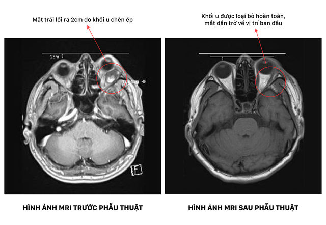 4 giờ nghẹt thở dưới k&iacute;nh vi phẫu giải cứu đ&ocirc;i mắt bị khối u ch&egrave;n &eacute;p - Ảnh 1.