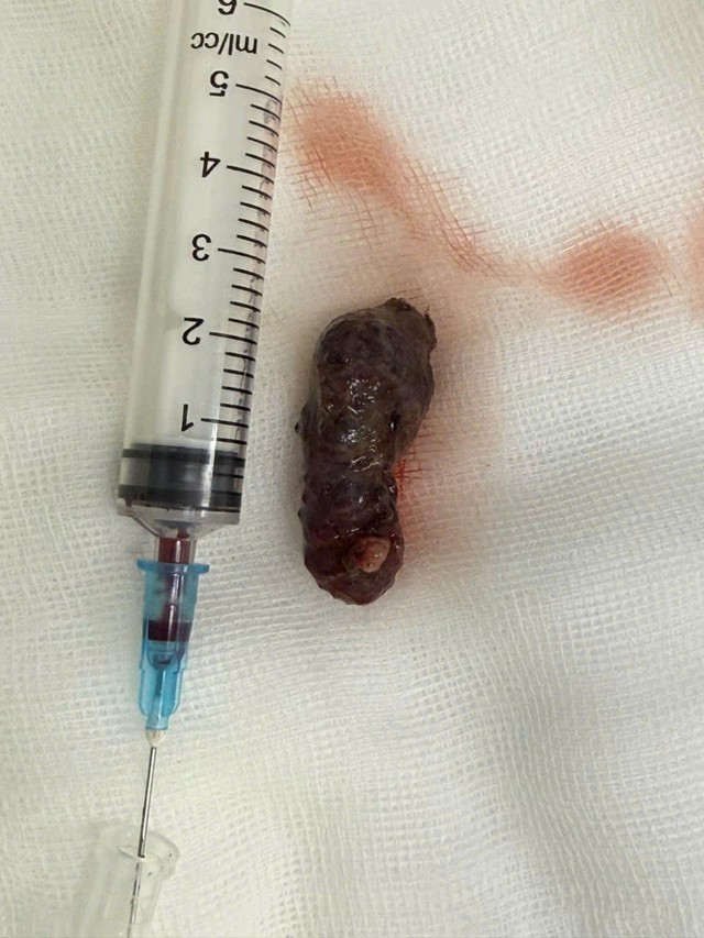 4 giờ nghẹt thở dưới k&iacute;nh vi phẫu giải cứu đ&ocirc;i mắt bị khối u ch&egrave;n &eacute;p - Ảnh 2.