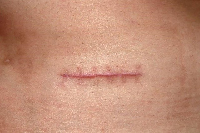 Định nghĩa lại phục hồi hậu phẫu: Từ &lsquo;liền thương&rsquo; đến &lsquo;liền thương c&oacute; kiểm so&aacute;t&rsquo; - Ảnh 1.