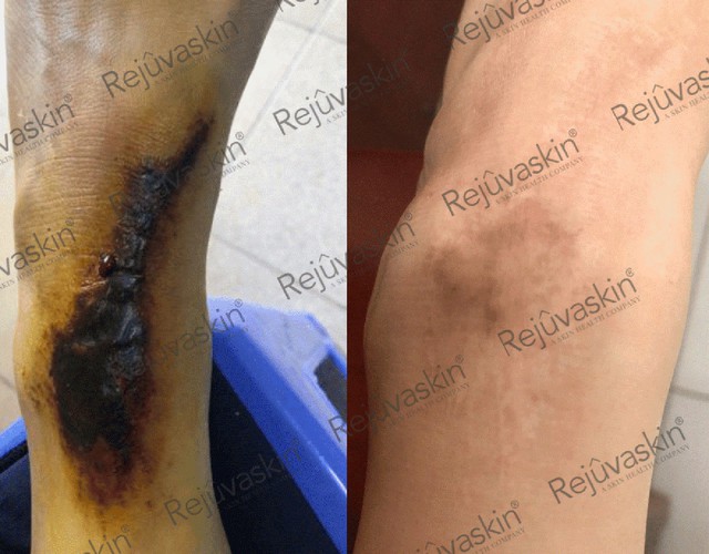 Sẹo ph&igrave; đại ở khớp: nguy&ecirc;n nh&acirc;n, nguy cơ v&agrave; hướng điều trị sớm - Ảnh 1.