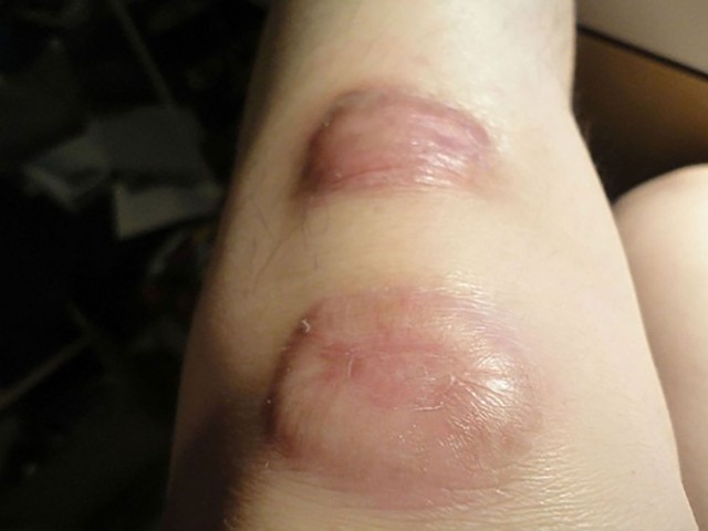 Sẹo ph&igrave; đại ở khớp: nguy&ecirc;n nh&acirc;n, nguy cơ v&agrave; hướng điều trị sớm - Ảnh 2.