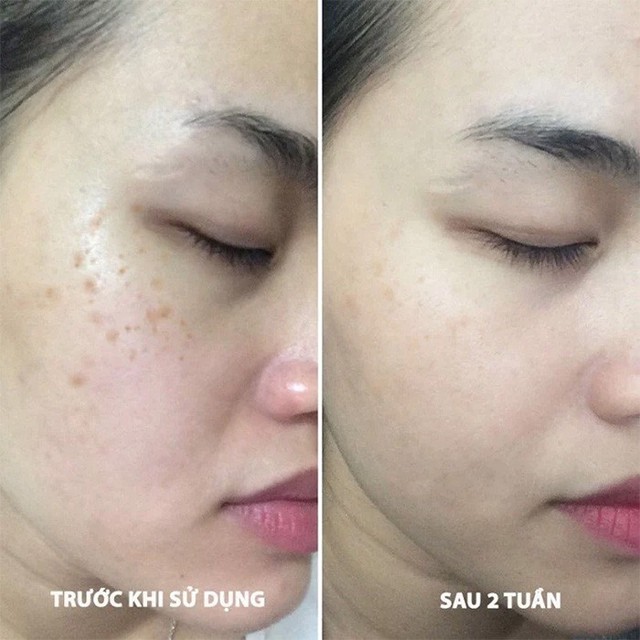 Top 5 serum gi&uacute;p &lsquo;tạm biệt&rsquo; n&aacute;m, thậm ch&iacute; n&aacute;m hỗn hợp tưởng như chưa tồn tại - Ảnh 1.