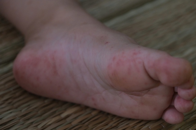 Bệnh tay ch&acirc;n miệng v&agrave; sốt xuất huyết gia tăng mạnh tại Cần Thơ - Ảnh 2.