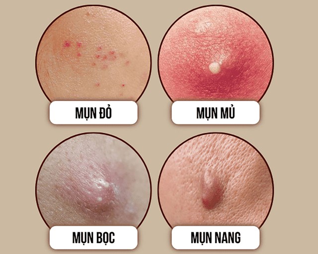 Kem gi&uacute;p giảm mụn bọc n&agrave;o đang viral v&igrave; hiệu quả sau 4 tuần m&agrave; kh&ocirc;ng th&acirc;m? - Ảnh 2.